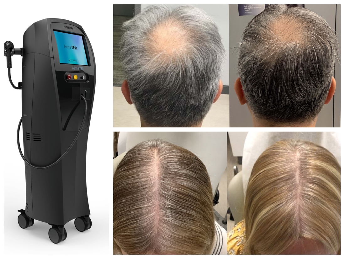 HPIHair: 1st in Nashville to begin TED Treatment!